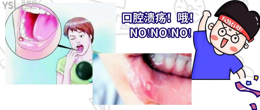 口腔潰瘍反復發(fā)作怎么<span style=