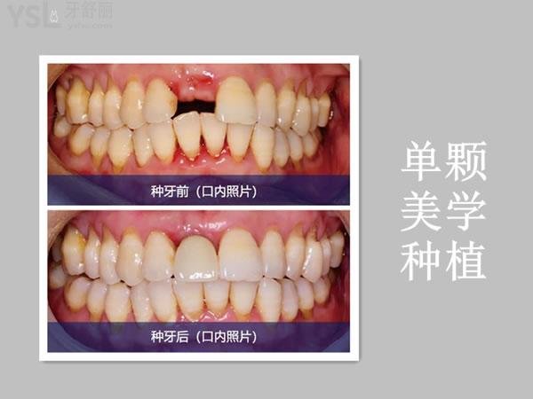 成都新橋口腔單顆種植事例