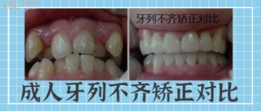 30歲齙牙可以矯正回來嗎