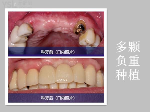 成都新橋口腔多顆種植事例