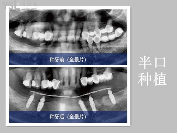 成都新橋口腔半口種植事例