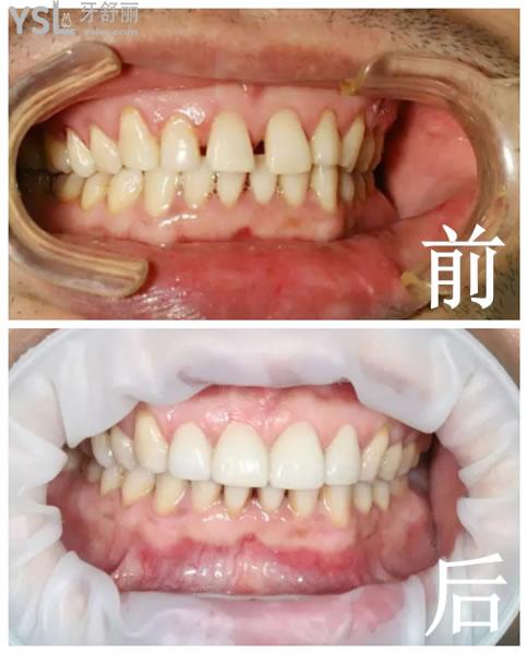 義獲嘉全瓷牙貼面術后成效圖