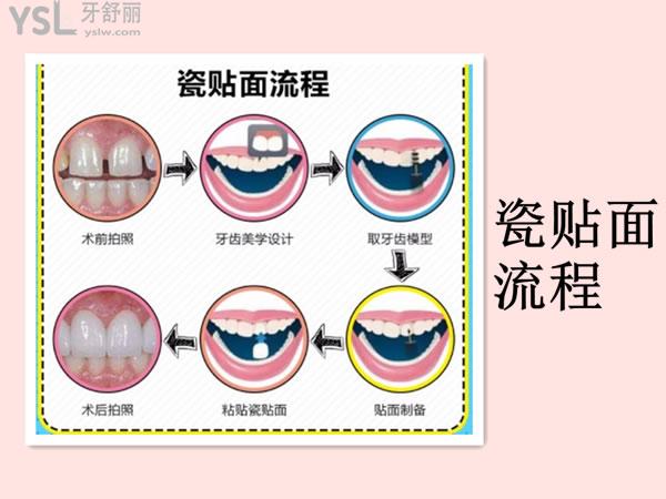 瓷貼面流程圖