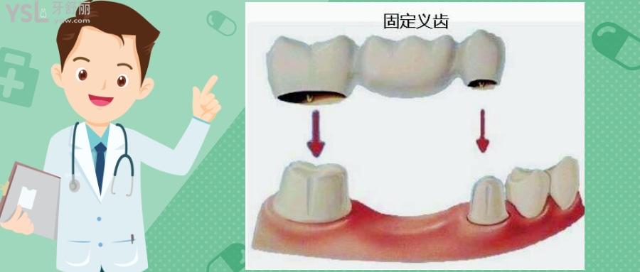 牙缺失除了種牙還有其他辦法嗎