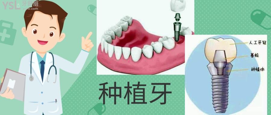 牙缺失除了種牙還有其他辦法嗎