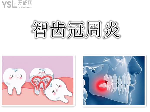 智齒冠周炎該如何治療