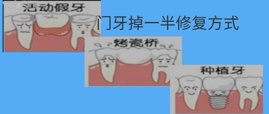 門牙掉一半修復(fù)多少錢