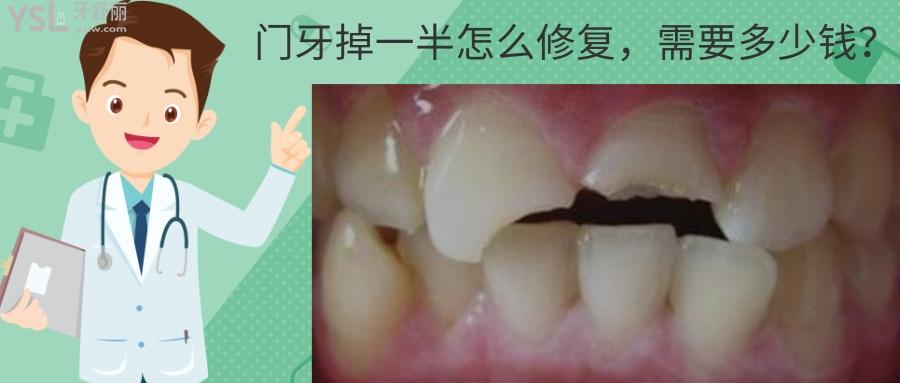 門牙掉一半修復(fù)多少錢