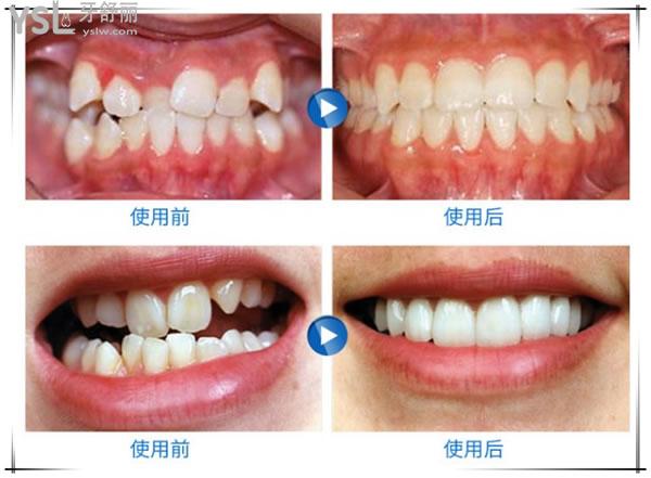 日照凱思口腔正畸病例