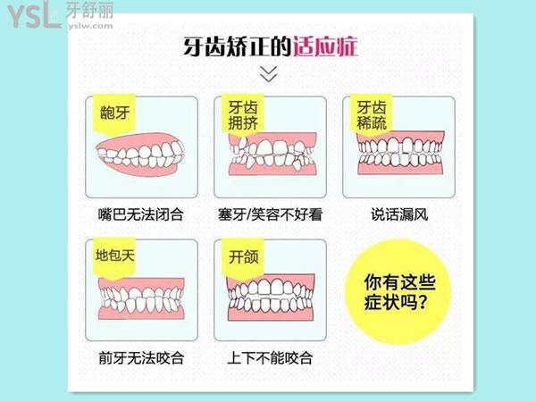 牙齒矯正的適應(yīng)癥