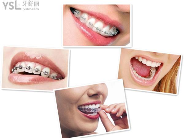 牙齒矯正4種牙套