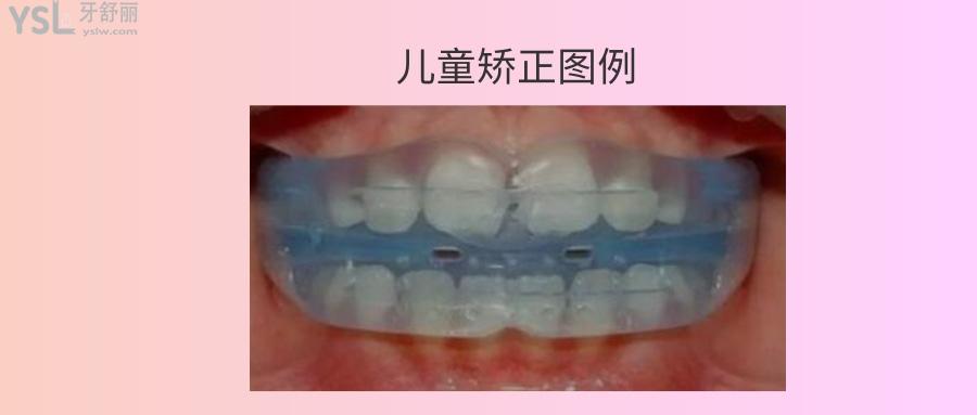 兒童牙齒矯正疼不疼