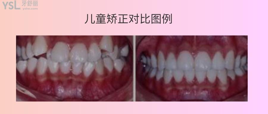 兒童牙齒矯正疼不疼