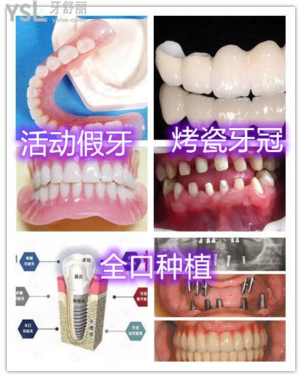 假牙種類