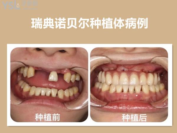 瑞典諾貝爾種植體病例