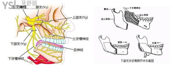 正頜手術(shù)