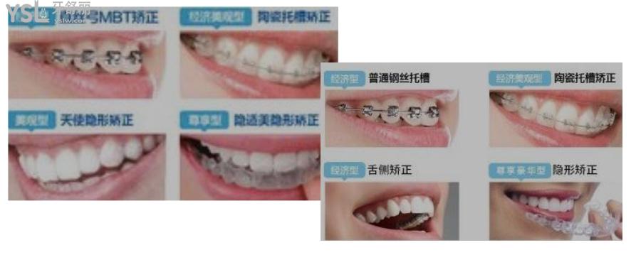 學(xué)生牙齒矯正大概要多少錢(qián)