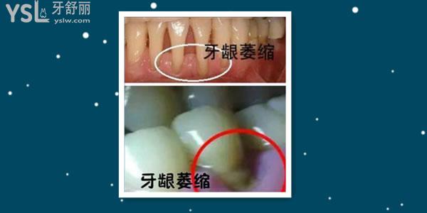 牙床萎縮可以重新嗎 看看醫(yī)生有什么建議.jpg
