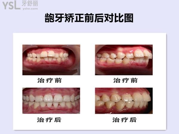 真實顧客齙牙矯正對比圖