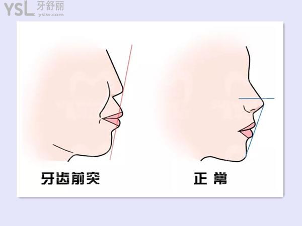 前突和正常牙齒對比