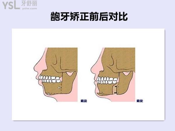 齙牙矯正前后對比