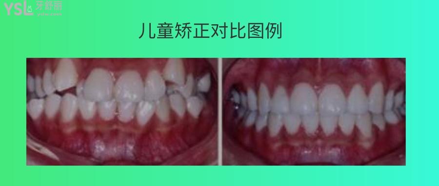 兒童正畸拔牙的危害