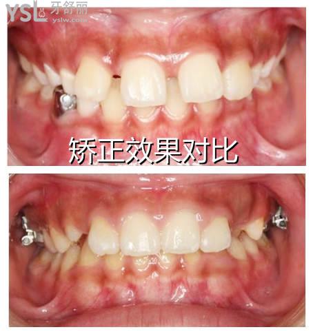 青少年牙齒矯正需要拔牙嗎