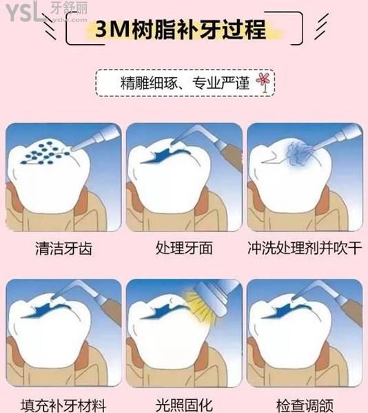 補(bǔ)牙過程