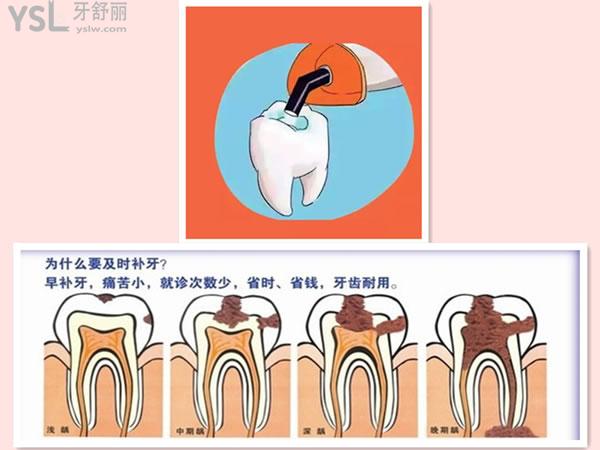 為什么要及時(shí)補(bǔ)牙