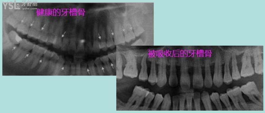 牙槽骨吸收了還可以種植牙嗎