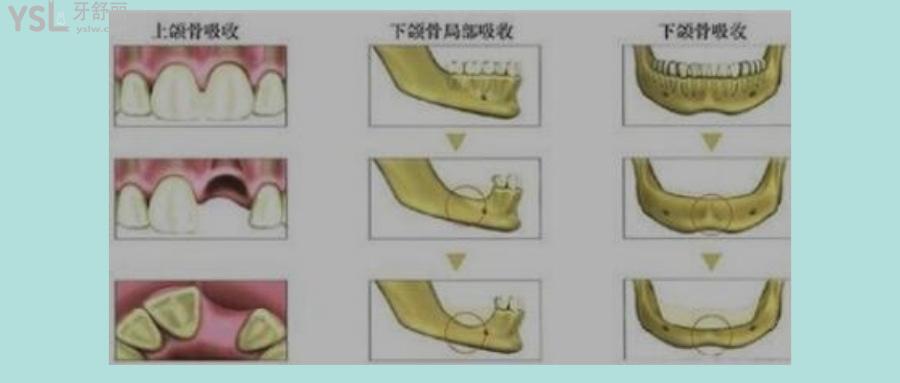 牙槽骨吸收了還可以種植牙嗎