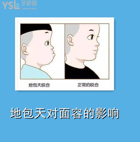 地包天矯正一般幾歲合適