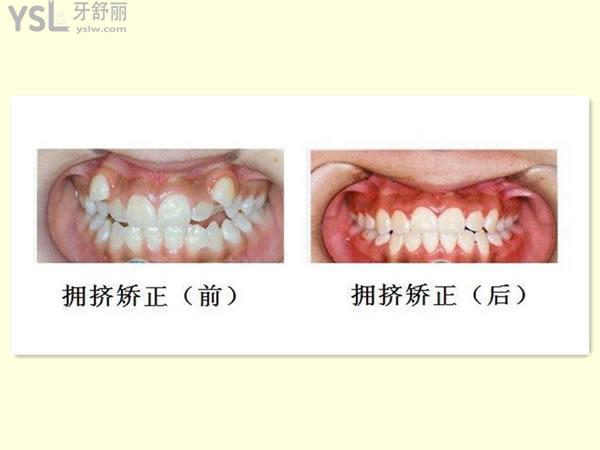 牙齒矯正對(duì)比圖