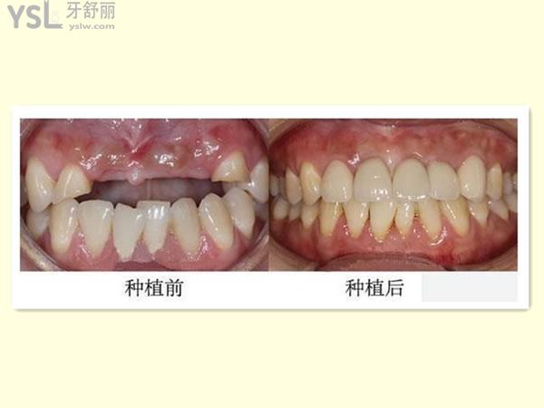 種植牙對(duì)比圖