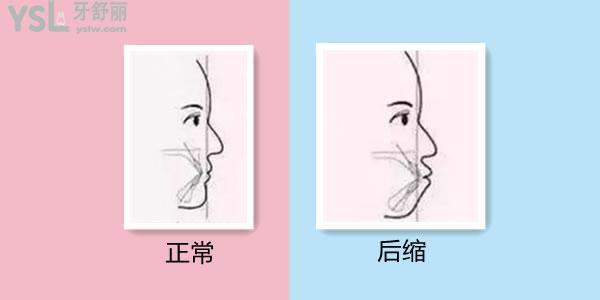  整牙對下巴后縮的治療有幫助嗎 幫助大嗎