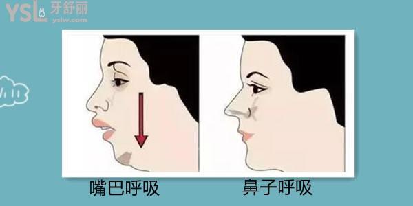  整牙對下巴后縮的治療有幫助嗎 幫助大嗎