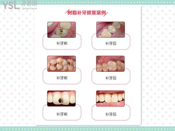 樹脂補牙對比圖