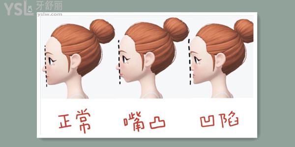 從側(cè)面看嘴凸怎么矯正· 還有其他解決方式嗎.jpg