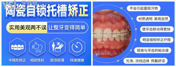 陶瓷半隱形矯正優(yōu)勢(shì)