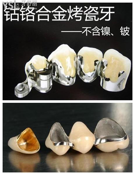 烤瓷牙