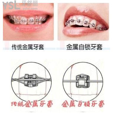 金屬自鎖牙套和傳統(tǒng)牙套的區(qū)別
