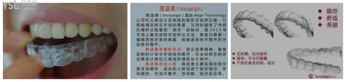 隱適美隱形牙套多少錢一副