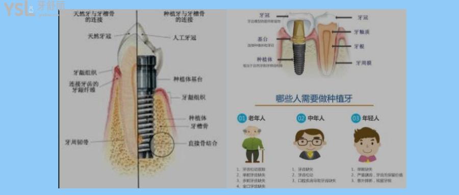 一顆種植牙價(jià)格為什么要這么貴