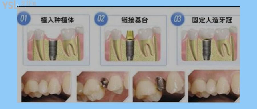 一顆種植牙價(jià)格為什么要這么貴