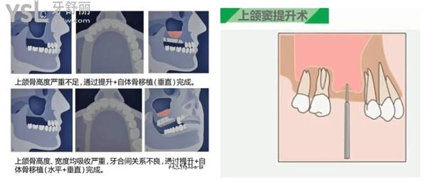 上頜竇提升術(shù)