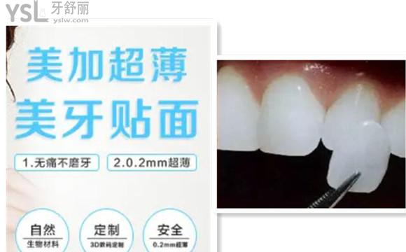 美加牙貼面價格