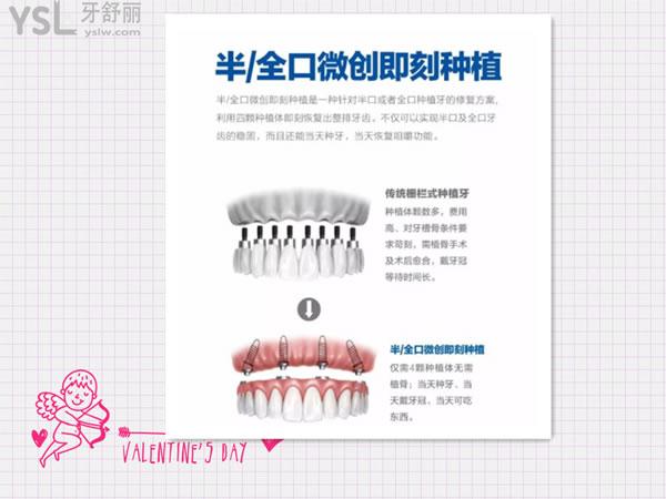 傳統(tǒng)種植和微創(chuàng)即刻種植的區(qū)別