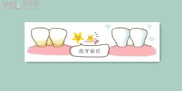 網(wǎng)上買的超聲波洗牙器有用嗎 為什么不建議使用