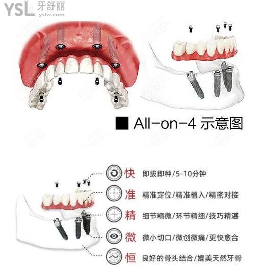 allon4半口要多少錢