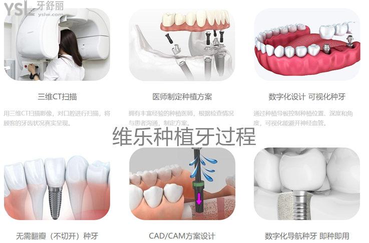 維樂口腔無錫維樂口腔種植牙價(jià)格表